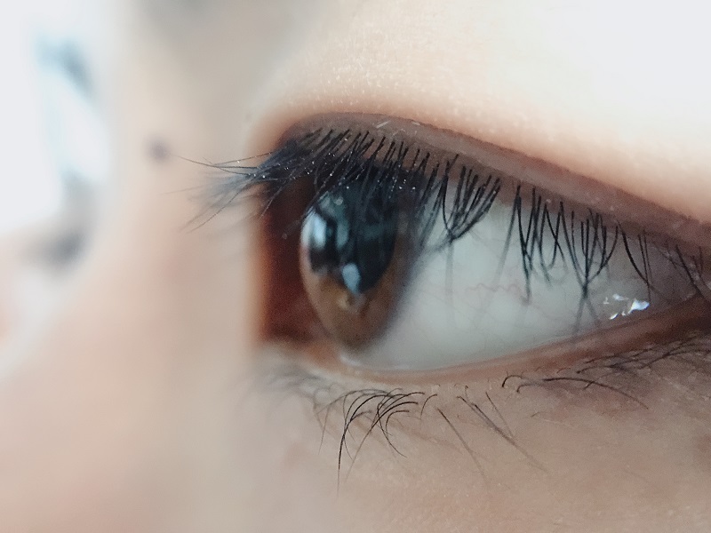 上眼皮為什么會(huì)下垂？上瞼下垂是怎么引起的？